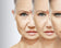 HIFU Facelift Training | 1-Day HIFU Beauty Course in Belgium